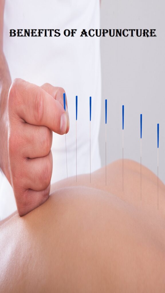 benefits of acupuncture