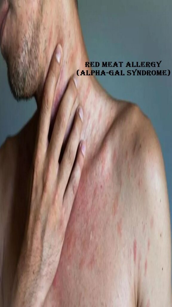 Red Meat Allergy (Alpha-Gal Syndrome)